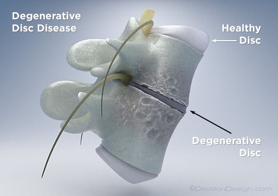 Disc Degeneration