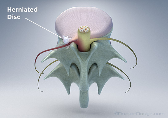 Herniated Disc