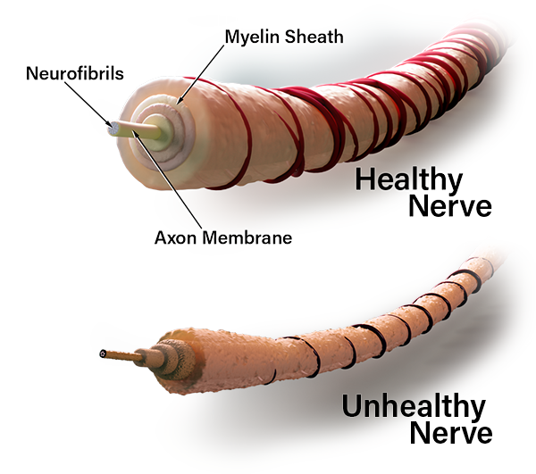 Neuropathy Nerve Damage