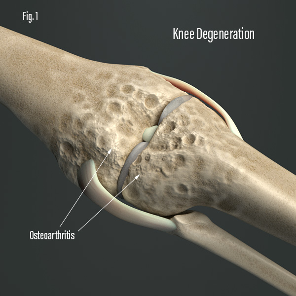 Osteoarthritis