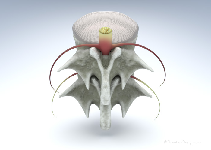 Spinal Stenosis