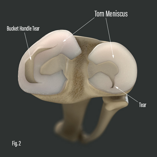 Torn Meniscus